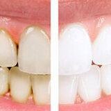 bleaching