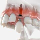 Dental Implants: Your Path to a Confident Smile and Lasting Oral Health