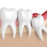 Realistic dentures before and after