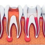 Best Cracked Tooth Root Canal Treatment