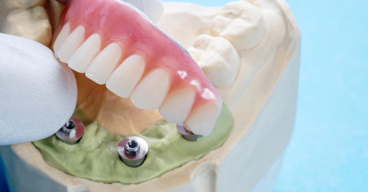 All-on-Four Dental Implants