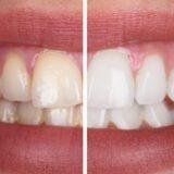 teeth whitening before after