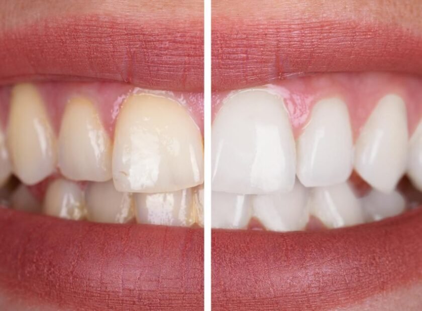 cosmetic teeth whitening