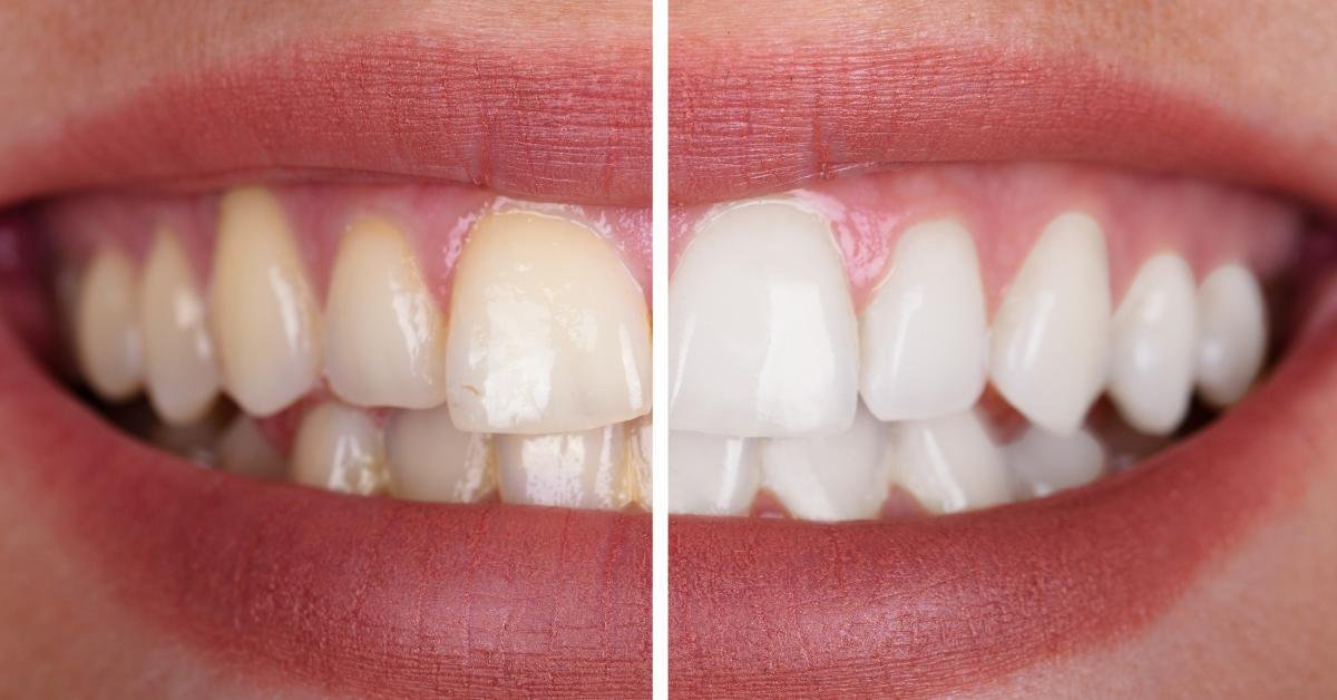 cosmetic teeth whitening