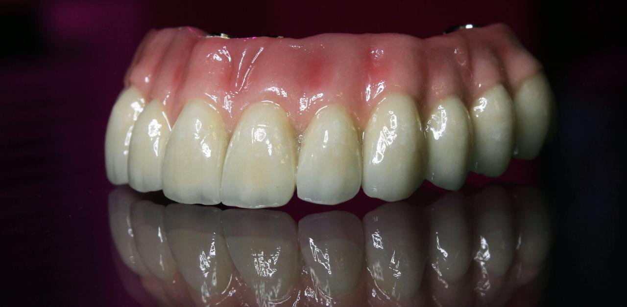 celebrity dental implants before and after