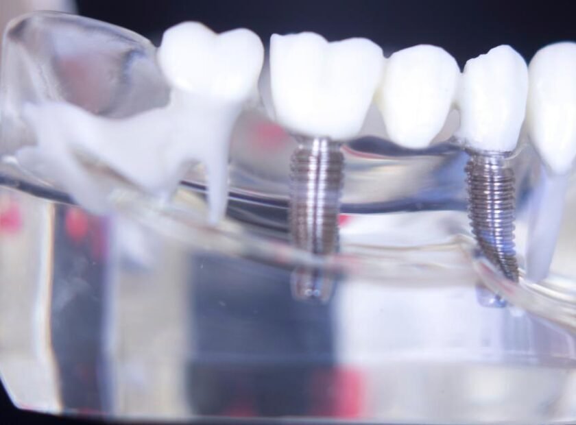 All-on-Four Dental Implants