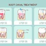 Root Canal Healing Time