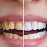Cosmetic Dental Crowns