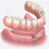 Lower denture implants