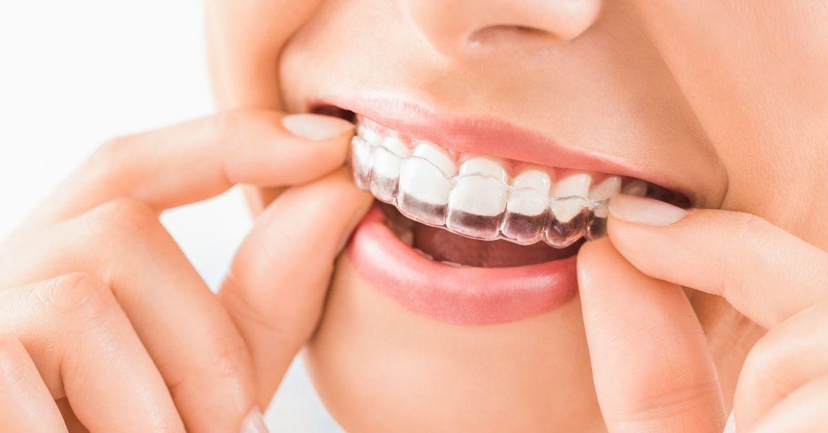 Clear Aligner