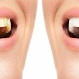 How Often Can You Whiten Your Teeth