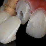Dentures vs Veneers