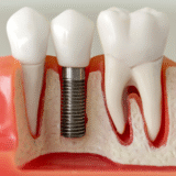 Affordable dental implants