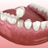 Dental crown without root canal