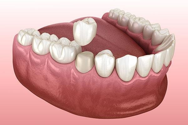 Preparated,Premolar,Tooth,And,Dental,Crown,Placement.,Medically,Accurate,3d