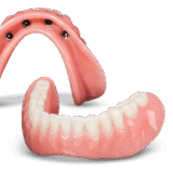 Implant partial denture