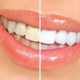 How long will teeth whitening last