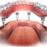 Dentures that are permanent