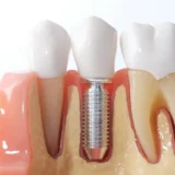 How long do dental implants last