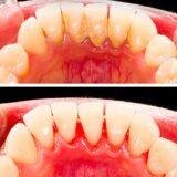 What is scaling in dentistry