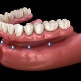 What do bottom dentures look like