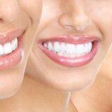 Cosmetic dentistry whitening