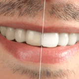 Teeth Whitening Edmonton