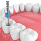 How long does it take to do a root canal?