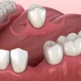 1 tooth partial denture