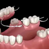 How long do dentures last?