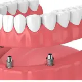 All on four dental implants