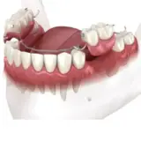 What do partial dentures look like?