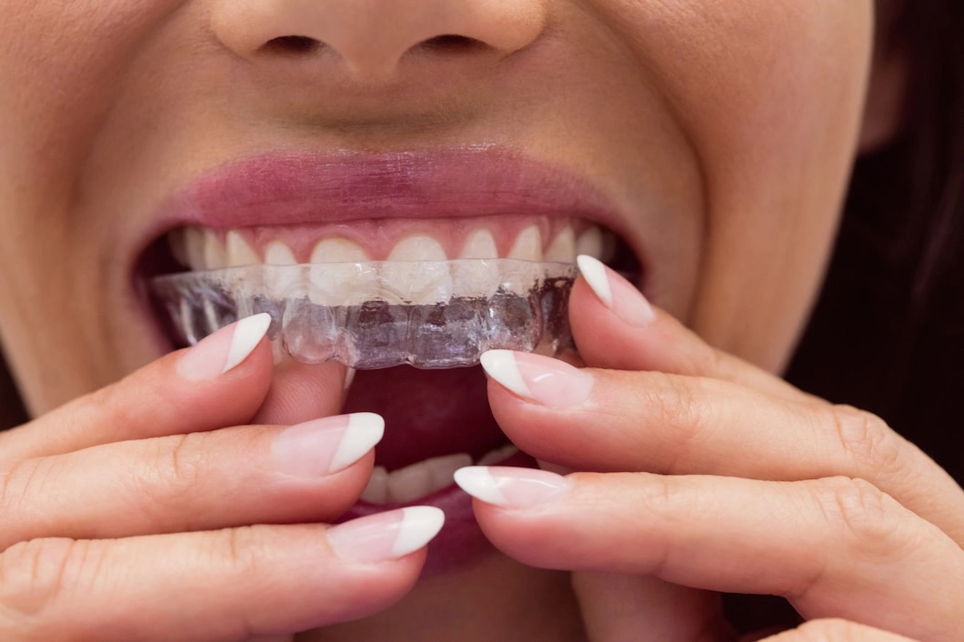 female-patient-wearing-braces_107420-65479